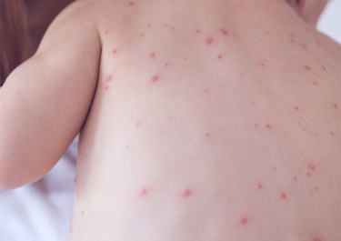 Health Department Measles Picture