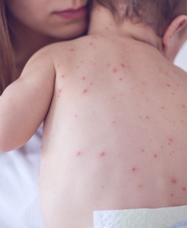 Health Department Measles Picture